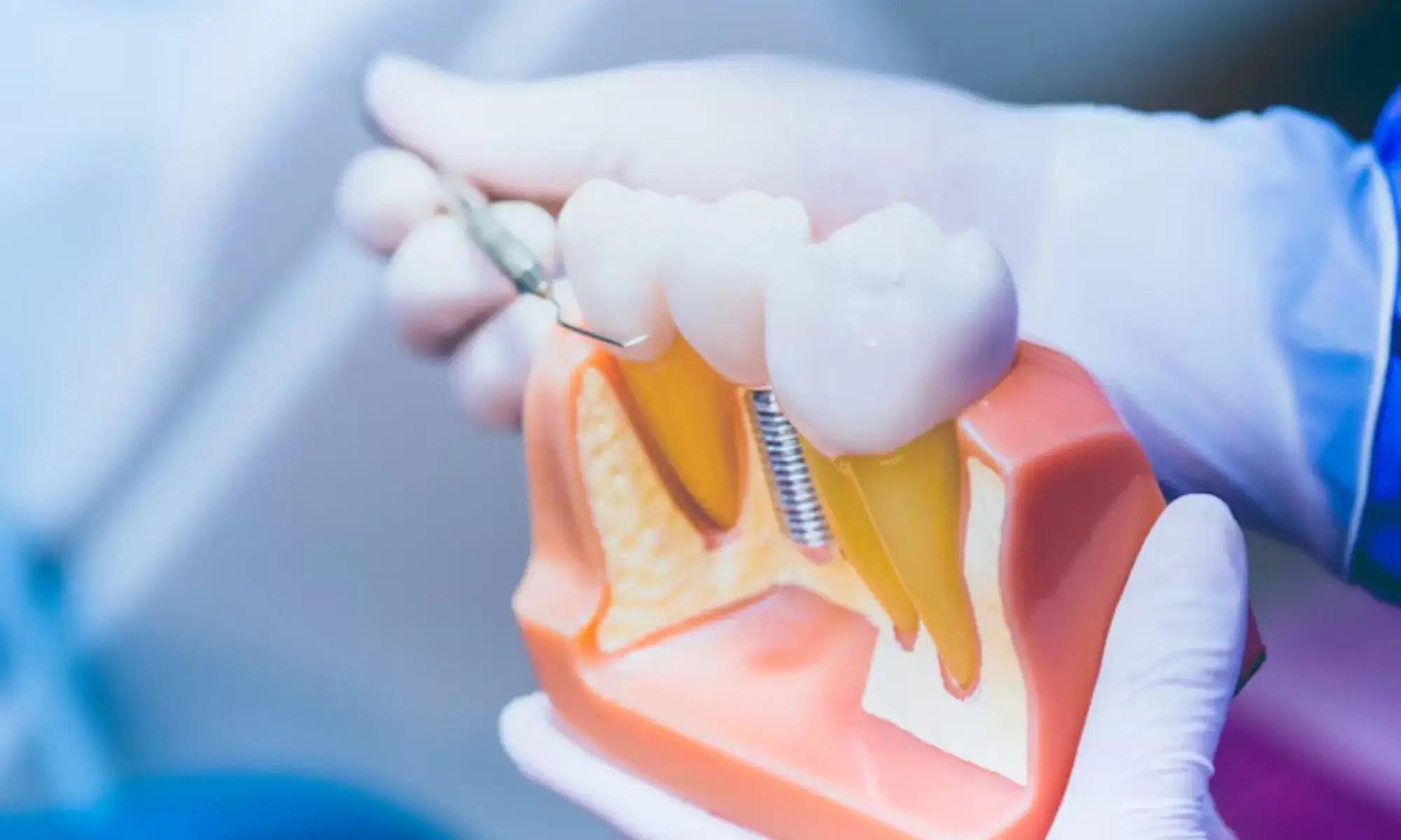 dental implants look amazing in 9 days