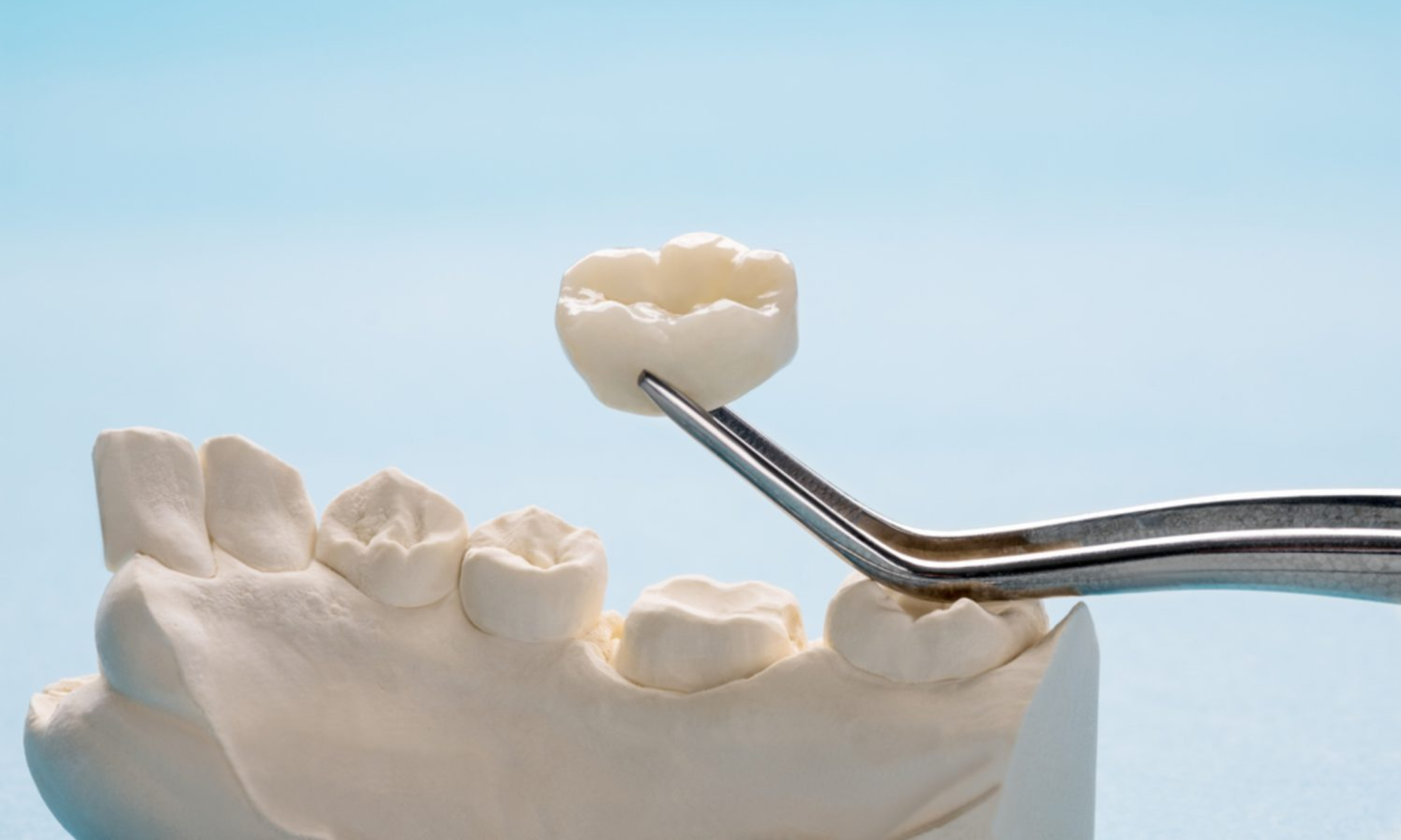 what to do when your dental crowns break