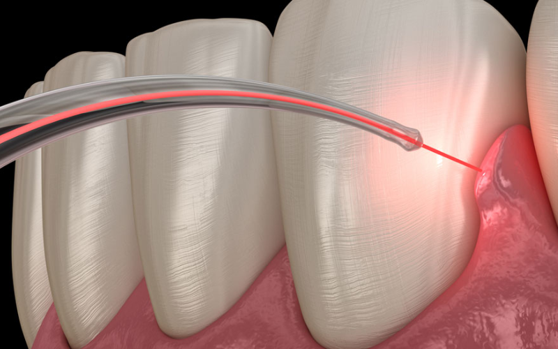 Everything About Gingivectomy