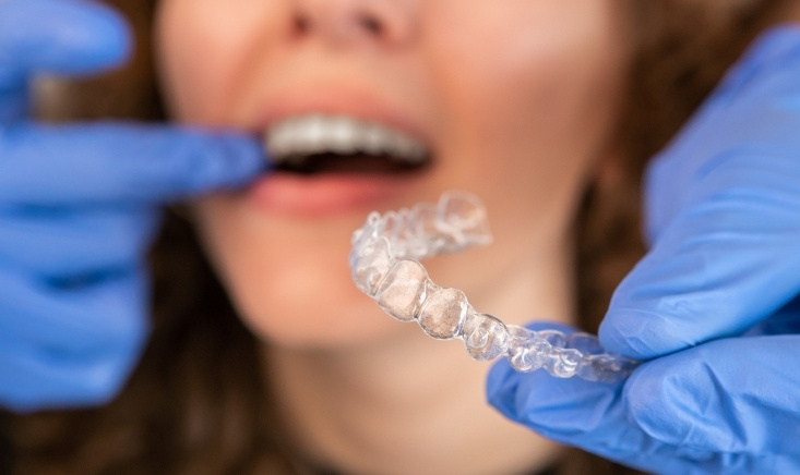 keep your invisalign aligners clean and clear