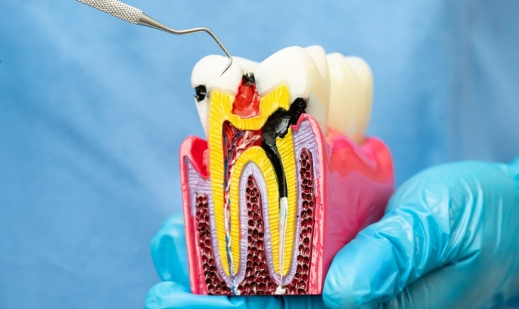 tooth pain could be a root canal issue