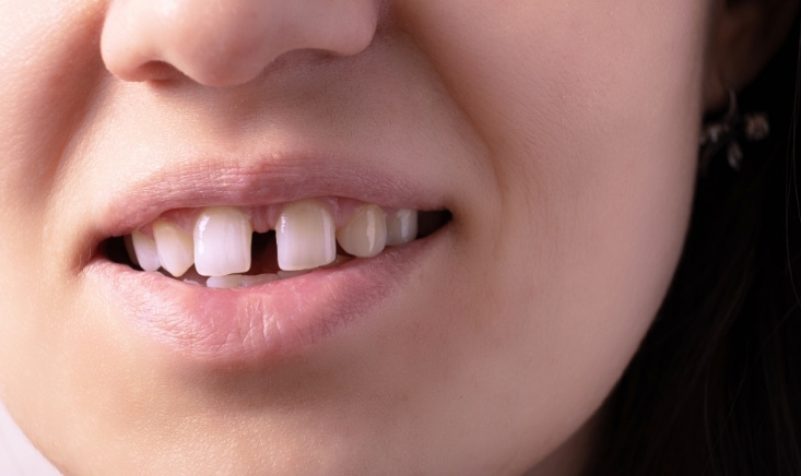 what is the reason for a teeth gap