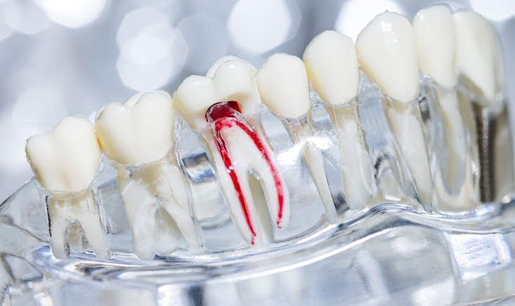 7 Signs You Might Need a Root Canal