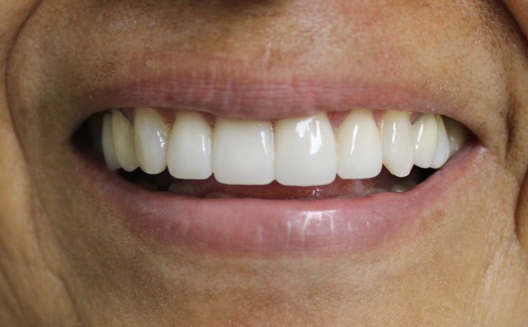 Teeth Cleaning in North Tustin