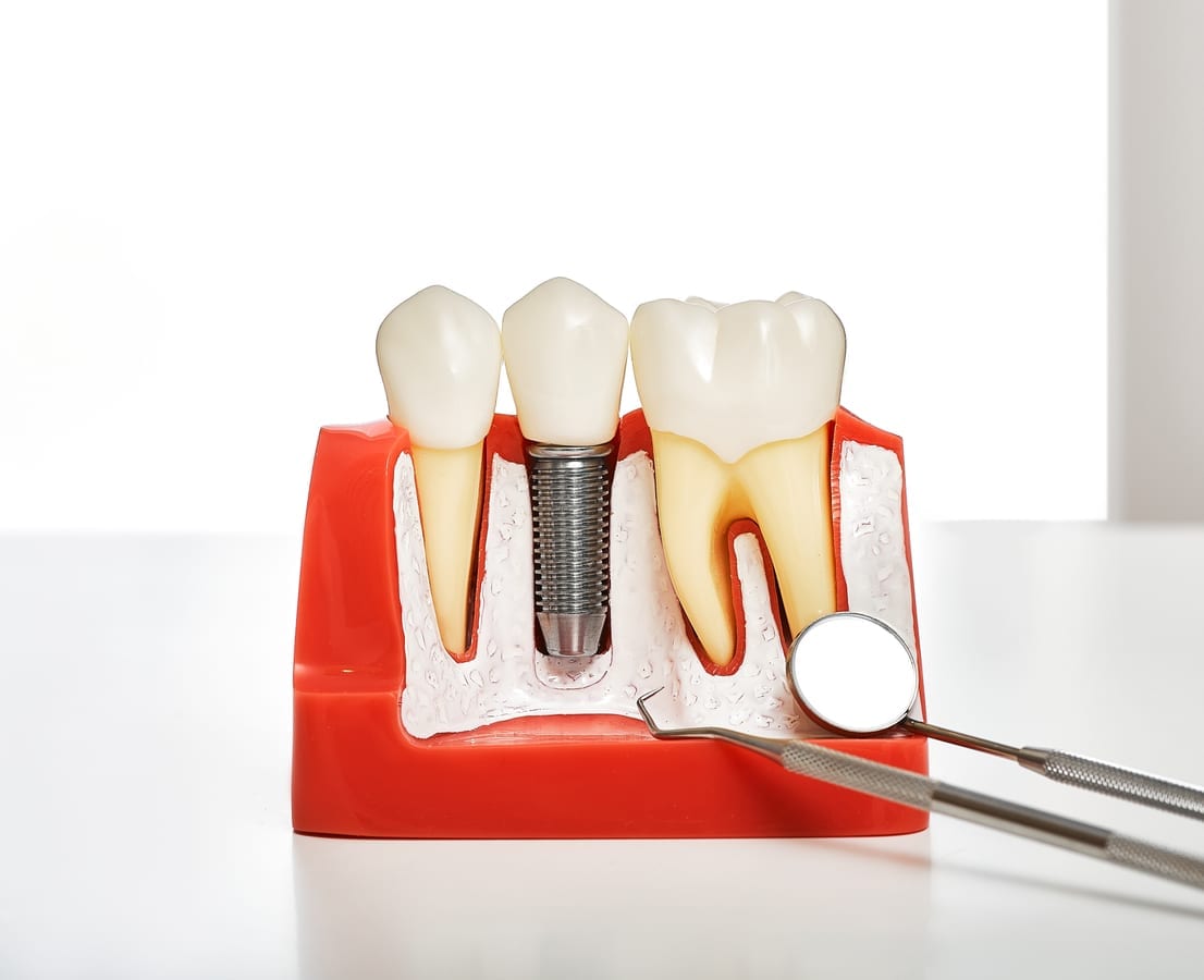 Dental Implants in Santa Ana