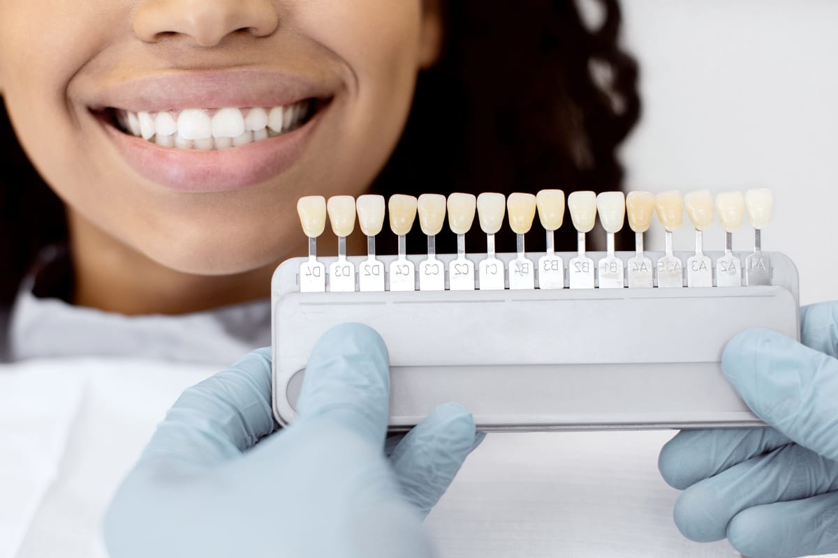 Veneers in California
