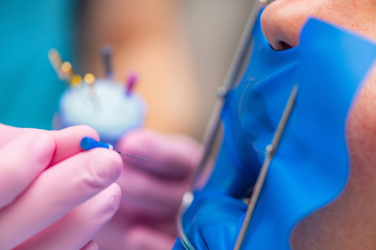 Root Canal Treatment in California